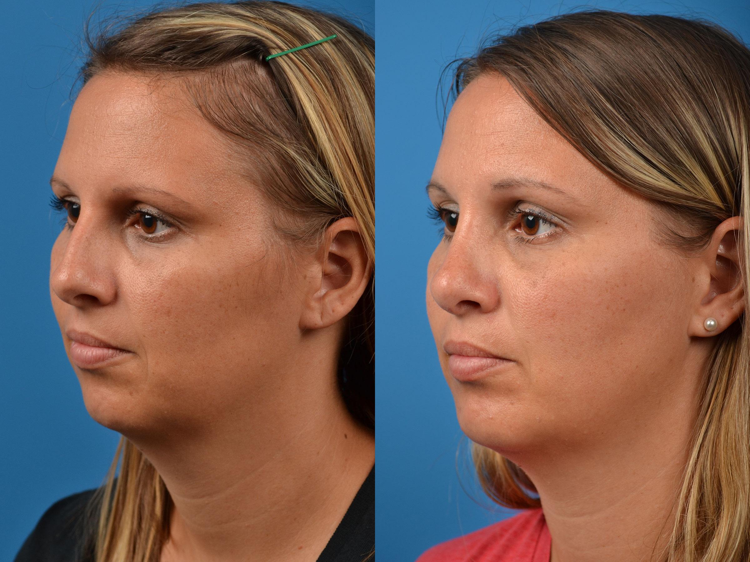 Rhinoplasty Photos Melbourne, FL Patient 55356